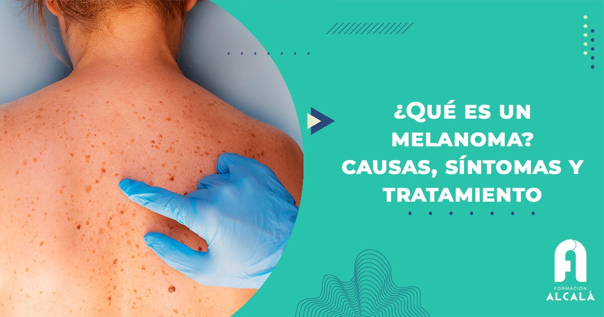 ¿qué Es Un Melanoma Causas Y Síntomas Formación Alcaláemk 9721